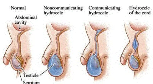 When to Get Hydrocele Operation Done: Adults, Children, Recovery